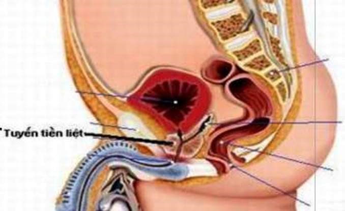 Viêm tiền liệt tuyến