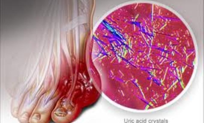 Acid uric
