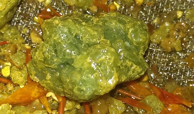 Sỏi túi mật