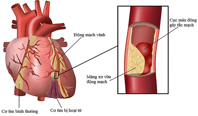 Bệnh tăng huyết áp và mỡ máu cao.