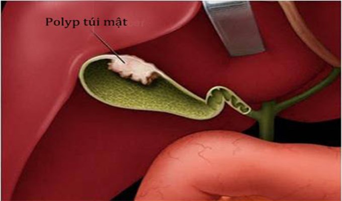 Polyp túi mật
